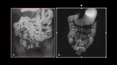 An enteroclysis (a.) and a filling sequence (b.) compared | Download Scientific Diagram