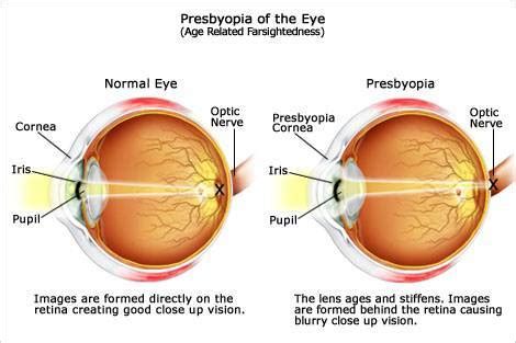 what are the causes of presbyopia - Science - The Human Eye and the ...