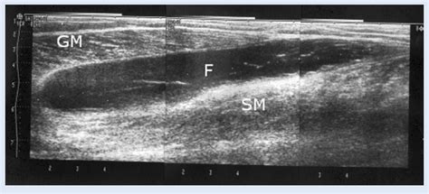 Gastrocnemius Tear Ultrasound