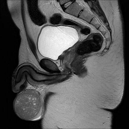 Testicular seminoma | Radiology Case | Radiopaedia.org