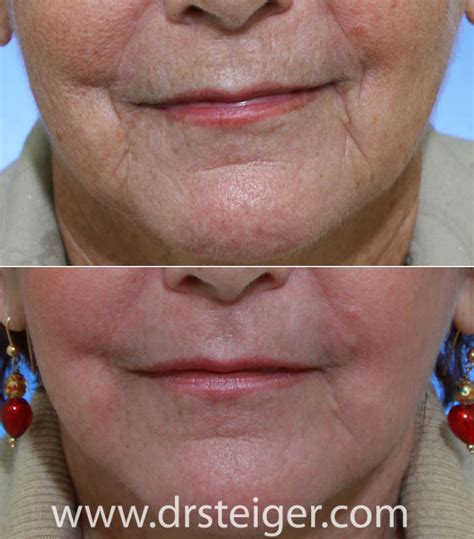 Fractional CO2 Laser Before and After Photos