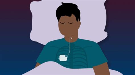 No More CPAP? What to Know About Inspire Sleep Apnea Treatment