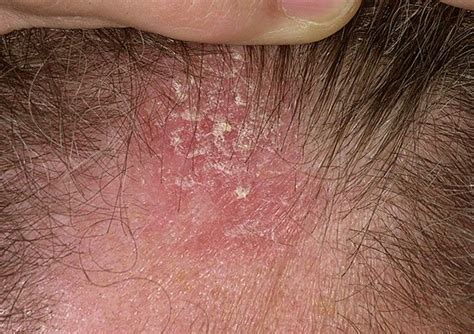 What’s Causing Seborrheic Dermatitis on Scalp? - All Rash