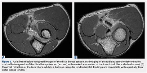 Magnetic Resonance Imaging Evaluation of the Distal Biceps Tendon | MDedge Surgery