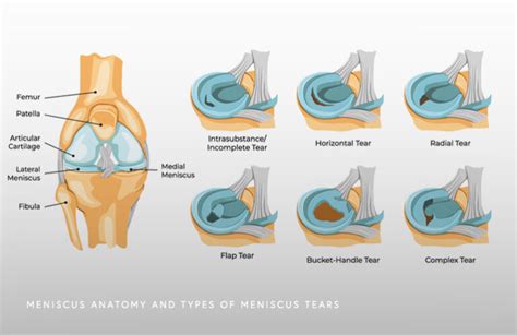 Meniscus Tear Schaumburg - Thomas Obermeyer, MD