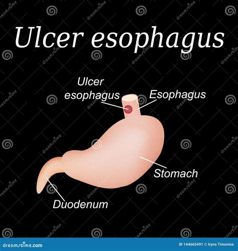 Esophagus Ulcer Affected. Ulcer Of Esophagus. Stomach Ulcer Affected ...