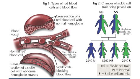 Sickle Cell Trait in Sports - Hughston Clinic