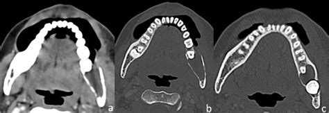 Axial CT scan images with soft tissue; (a): and bone window; (b,c ...