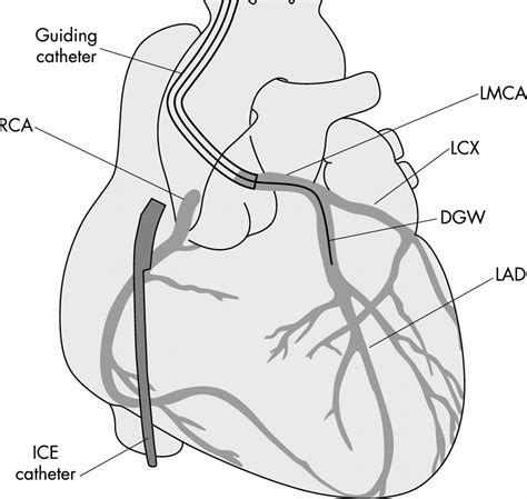 Ultimate Radiology : Left Coronary Catheter