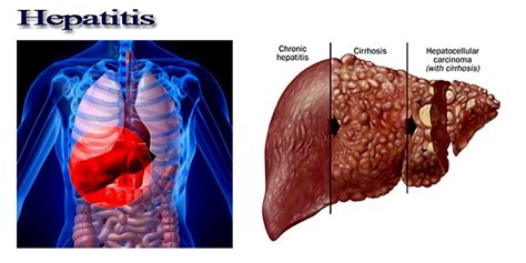 Hepatitis - Dr.Thind