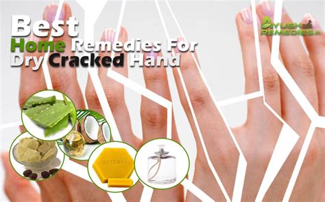 4 Natural Home Remedies for Dry Cracked Hands, Get Rid of Rough Hand ...