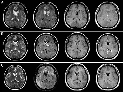 Figure 2 from Time course of Hashimoto's encephalopathy revealed by MRI ...