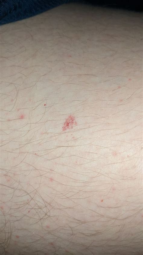 What is this (maybe burst blood vessel) : r/Dermatology