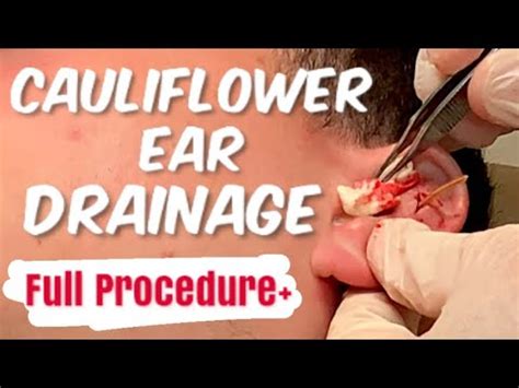 CAULIFLOWER EAR DRAINAGE | Removing Blood From Under Skin | EXTREME PAINFUL post | Full ...