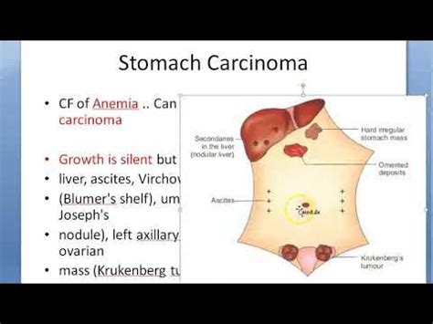 Surgery Stomach Carcinoma spread silent cancer Blumer shelf Sister mary joseph nodule Irish ...