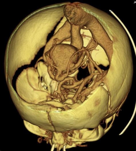 ABC Radiology Blog: Vein of Galen Malformation