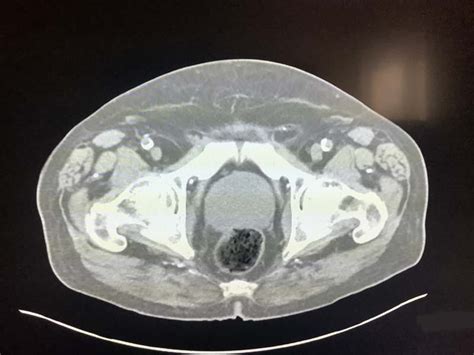 Enlarged Prostate On CT – Radiology In Plain English