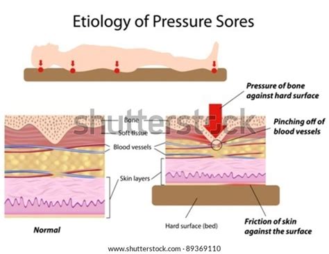 Causes Pressure Sores Stock Vector (Royalty Free) 89369110