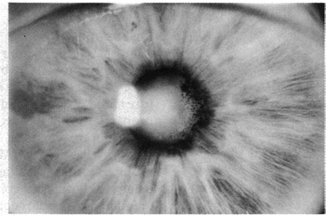 Case 6. Posterior synechiae after repeated episodes ofanterior uveitis. | Download Scientific ...