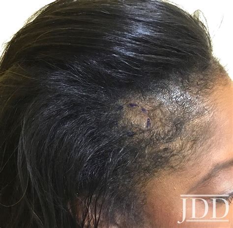 Frontal Fibrosing Alopecia Presenting as Androgenetic Alopecia in an African American Woman ...