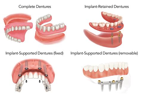 Treatment Options for the Edentulous Patient (including All-On-4 ...