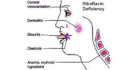 Vitamin B2 & Deficiency - www.medicoapps.org