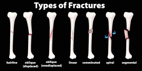 Types of Fractures - The Things You Need To Know | OPA