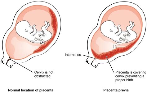 Placenta Praevia - Causes - Clinical Features - Management - TeachMeObGyn