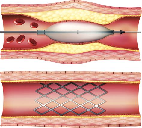 Interventional Cardiology: A Look Back at 4 Decades of Practice-Changing Innovation