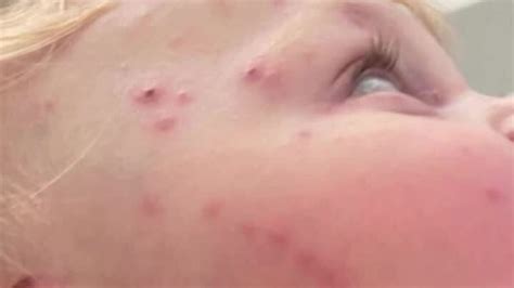 Chickenpox vaccine: What you need to know | News UK Video News | Sky News