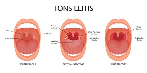 Angina, pharyngitis and tonsillitis. Tonsillitis bacterial and viral. Tonsil infection. Open ...