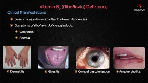 Corneal Vascularization Riboflavin