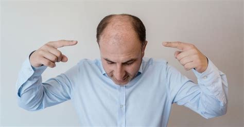 What Are Signs of Balding at 20 for Men?