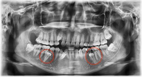 Buried/Extra (Supernumerary) Teeth Removal - Tes Clinic for Face and Jaw