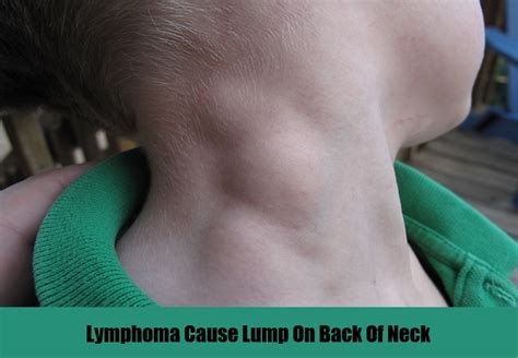 Causes & Symptoms Of Lump On Back Of Neck – Natural Home Remedies & Supplements