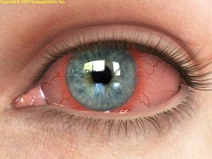 Anterior Uveitis - Pingree Eye Center