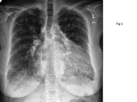 Calcified lymph nodes and systemic sclerosis | MJR - Mediterranean ...