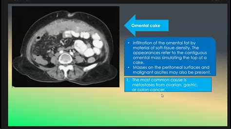 Omental Cake in Peritoneal Carcinomatosis - YouTube