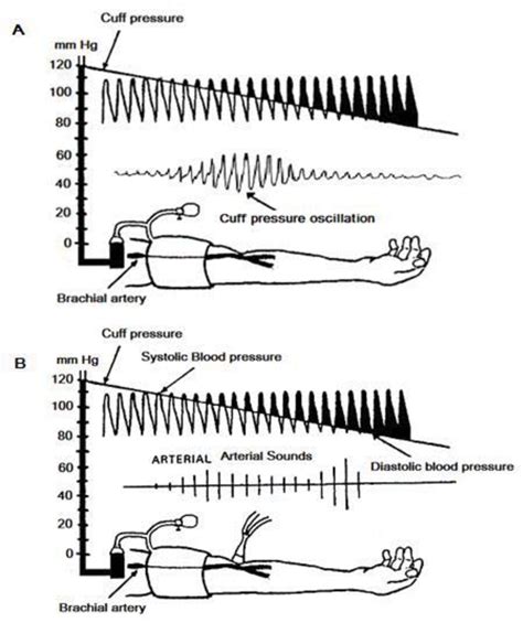 Figure 1 from Non-invasive blood pressure measurement: Auscultatory method versus oscillometric ...