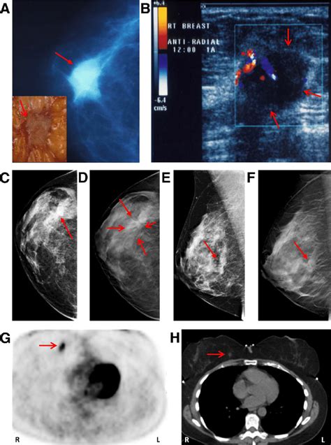 Imaging techniques for breast cancer screening and diagnosis. A ...