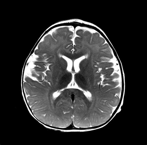 the brain is shown in black and white, with an area where it can be seen