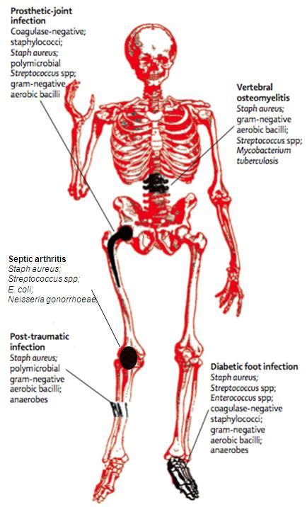 Osteomyelitis, Infectious Diseases - Infectious Disease Advisor