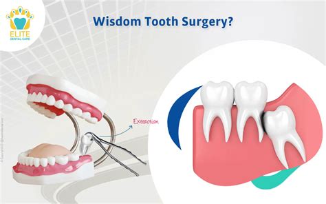 Is Wisdom Tooth Removal Considered Surgery