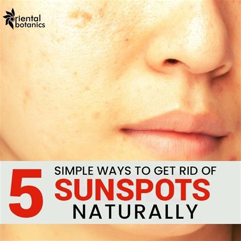 5 Simple Ways To Get Rid Of Sunspots Naturally | Sun spots on skin ...