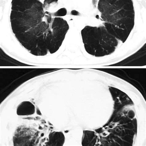 Chest CT scan revealed a widespread mosaic pattern with air trapping ...