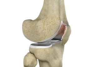 Chondromalacia Patellae Symptoms and Treatment