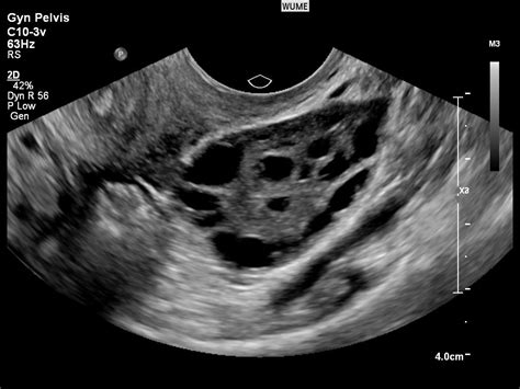 Gynaecology Ultrasound - Women's Ultrasound Melbourne