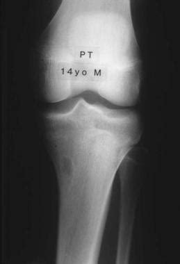 Fibrous Cortical Defect Symptoms, Images and Treatments | New Health Advisor