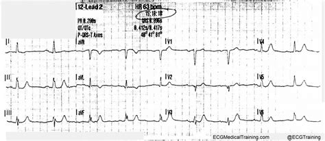 De Winter ST/T-Waves - ECG Medical Training