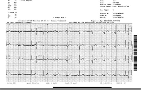 Non specific intraventricular conduction delay : r/medical